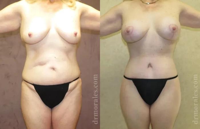 Before & After Body Lift Case 109 View 1 View in Houston, TX