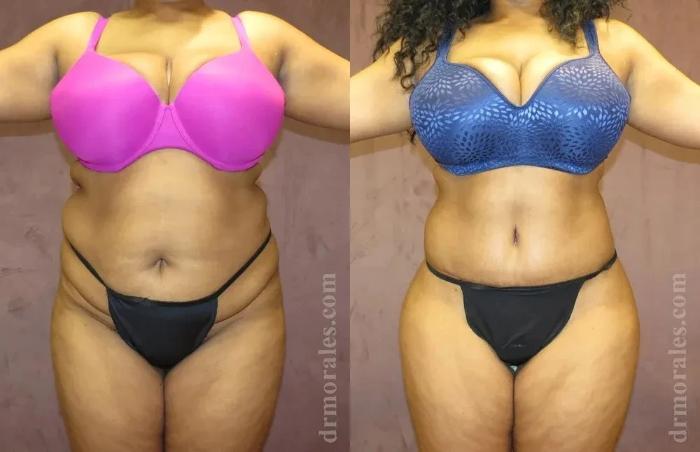 Before & After Body Lift Case 110 View 1 View in Houston, TX