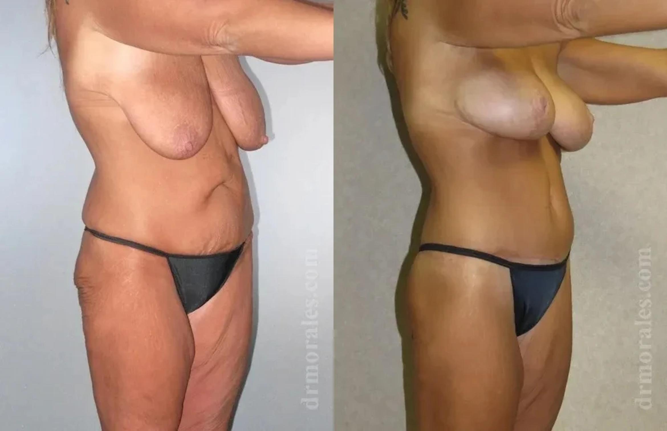 Before & After Body Lift Case 111 View 1 View in Houston, TX