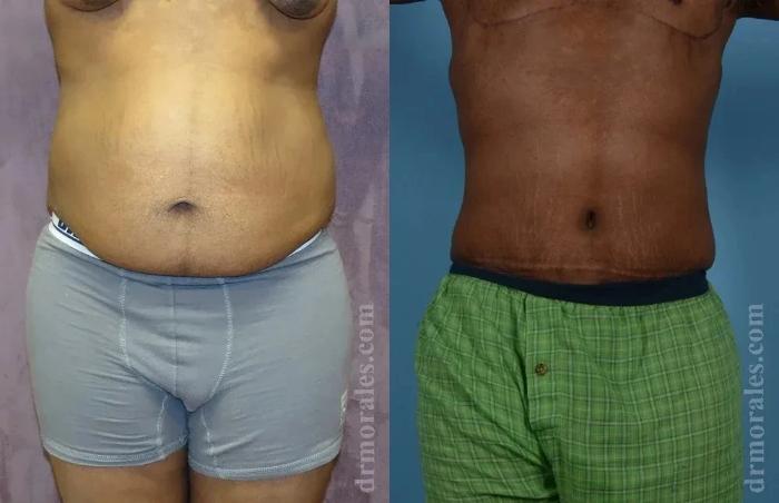 Before & After Body Lift Case 112 View 1 View in Houston, TX