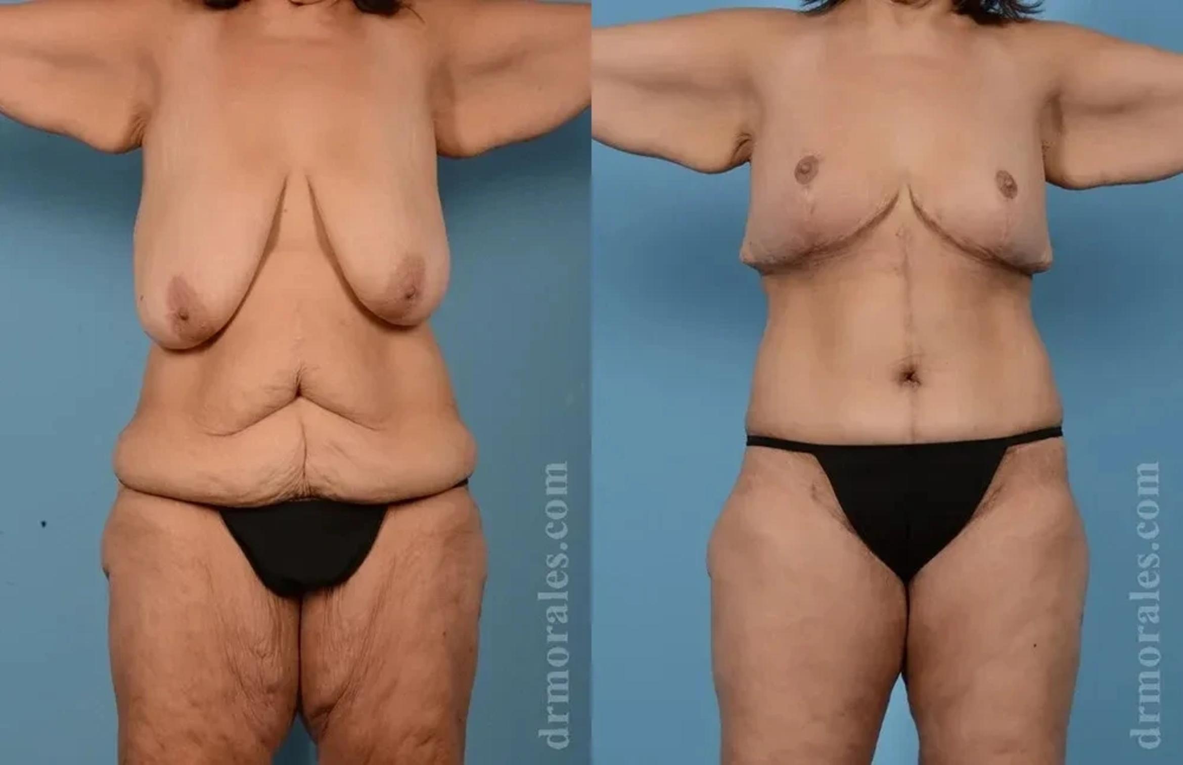 Before & After Body Lift Case 113 View 1 View in Houston, TX