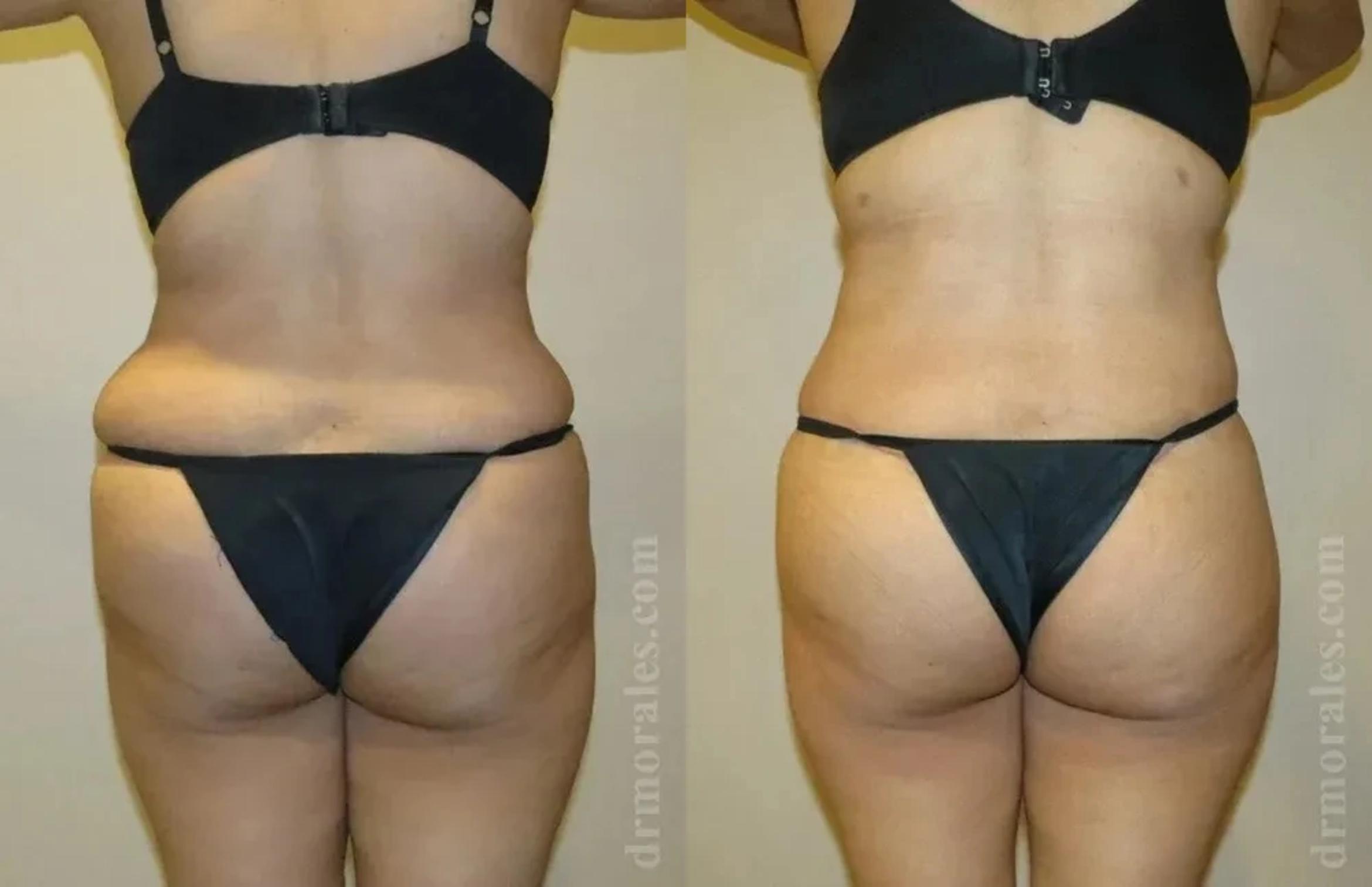 Before & After Body Lift Case 114 View 1 View in Houston, TX