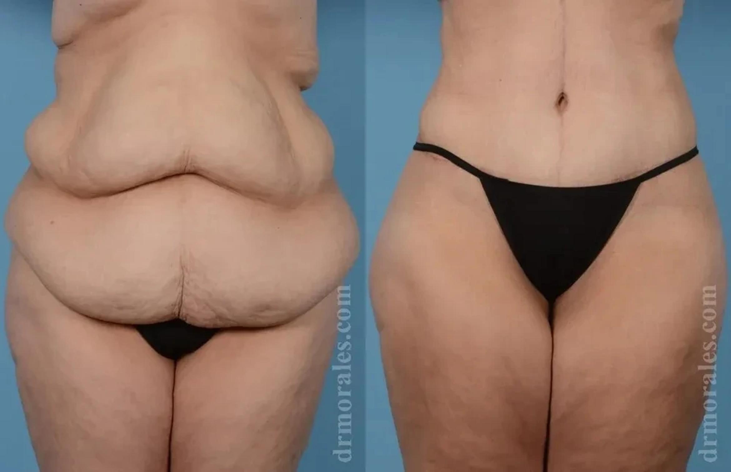 Before & After Body Lift Case 115 View 1 View in Houston, TX