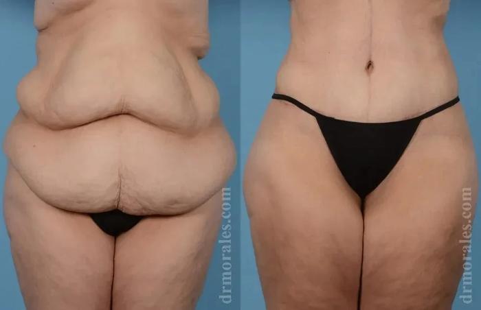 Before & After Body Lift Case 115 View 1 View in Houston, TX