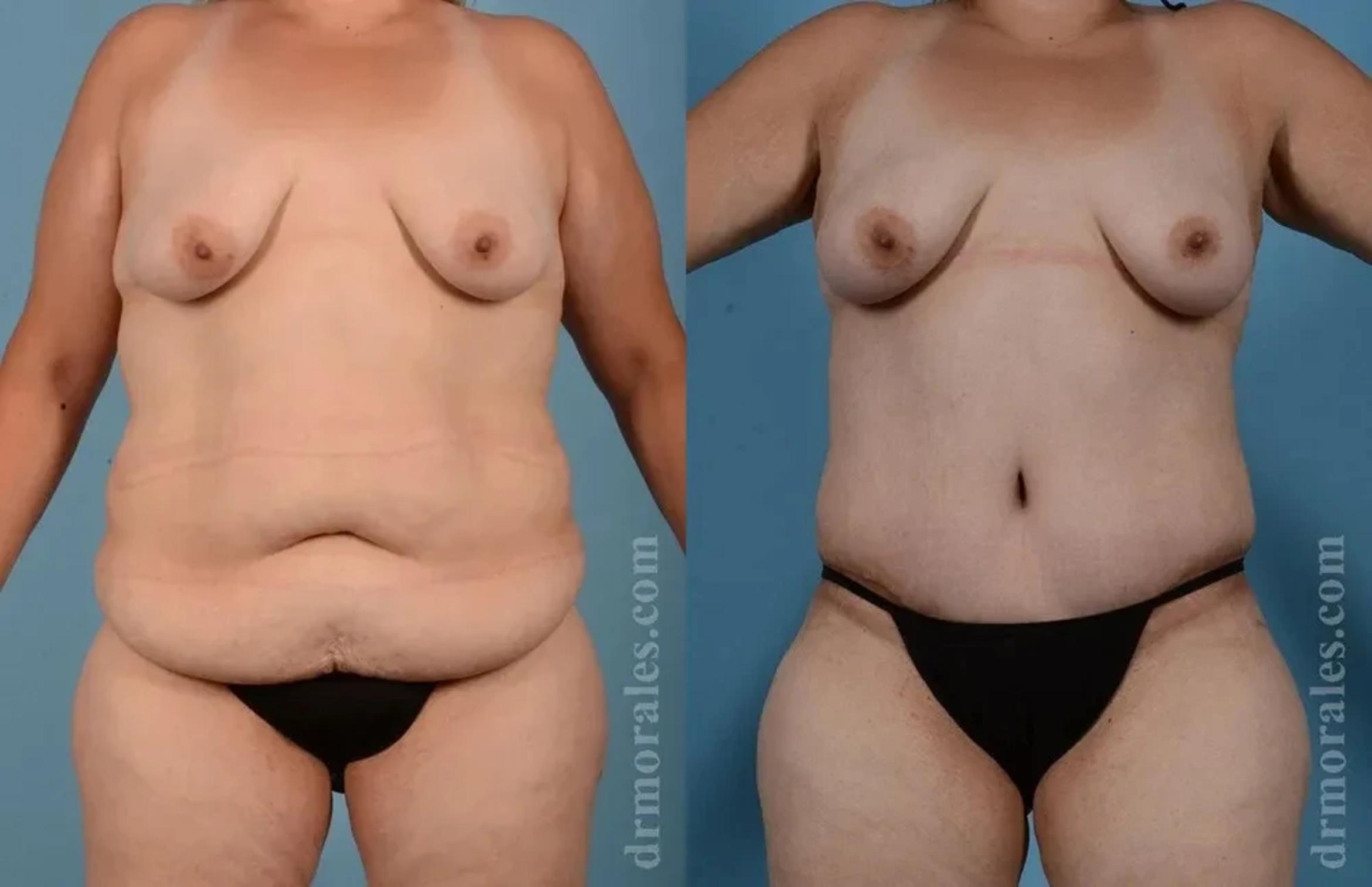 Before & After Body Lift Case 116 View 1 View in Houston, TX