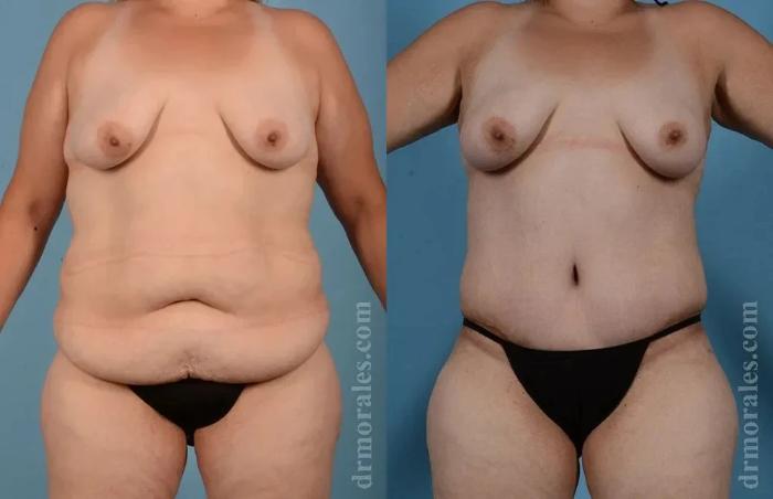 Before & After Body Lift Case 116 View 1 View in Houston, TX