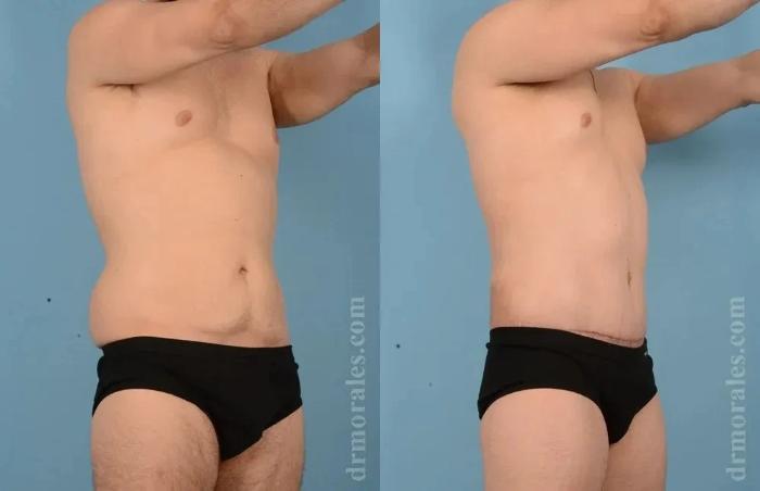 Before & After Body Lift Case 117 View 1 View in Houston, TX