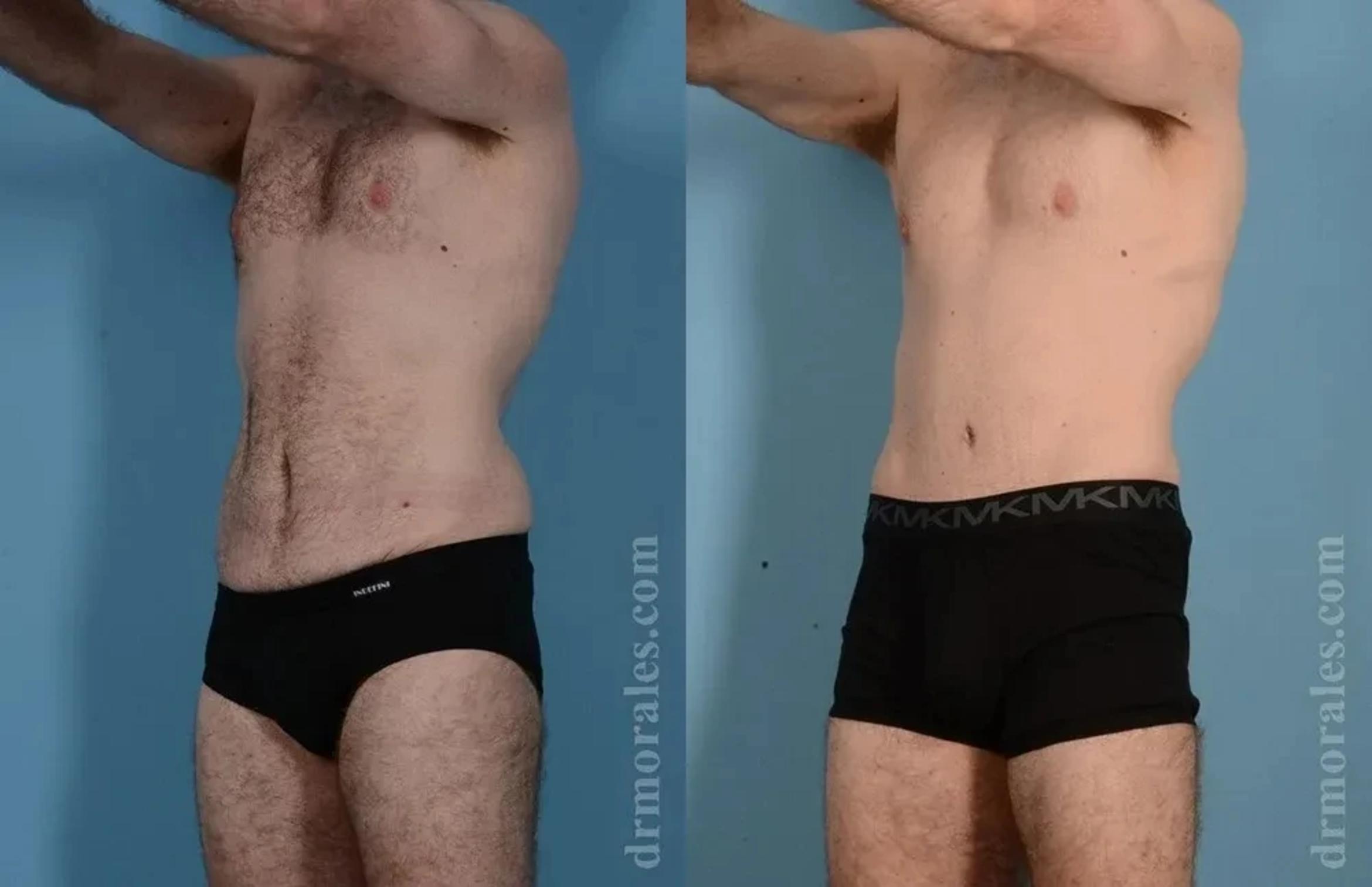 Before & After Body Lift Case 118 View 1 View in Houston, TX