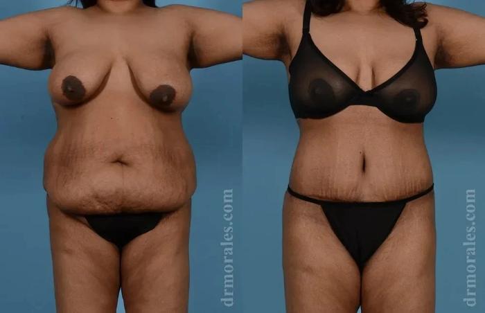 Before & After Body Lift Case 119 View 1 View in Houston, TX