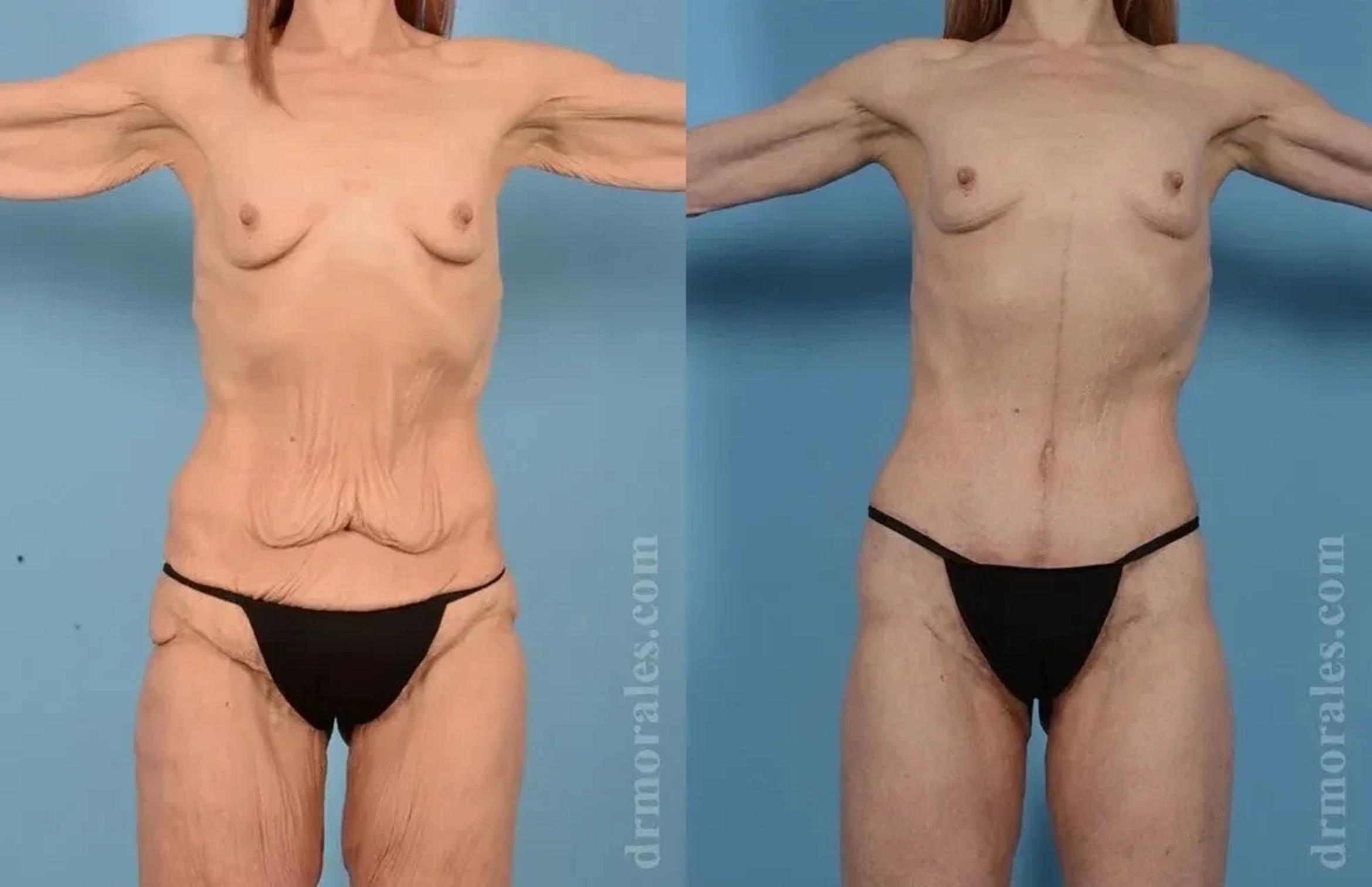 Before & After Body Lift Case 120 View 1 View in Houston, TX