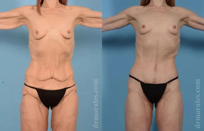 Before & After Body Lift Case 120 View 1 View in Houston, TX