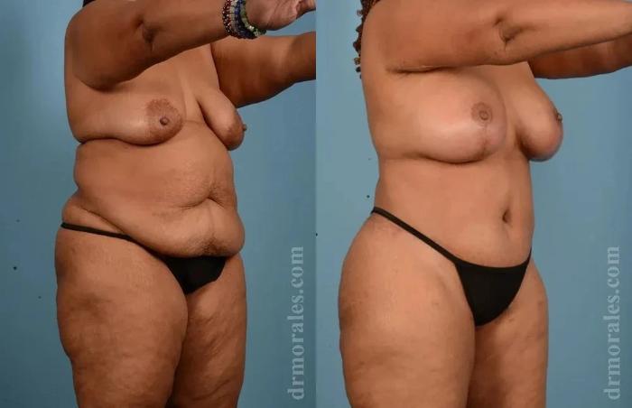 Before & After Body Lift Case 121 View 1 View in Houston, TX