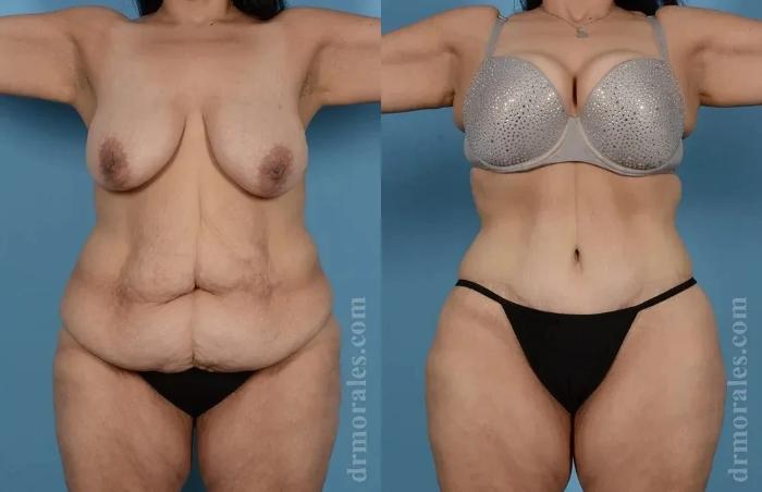 Before & After Body Lift Case 122 View 1 View in Houston, TX