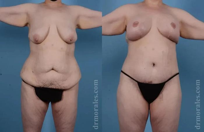 Before & After Body Lift Case 125 View 1 View in Houston, TX