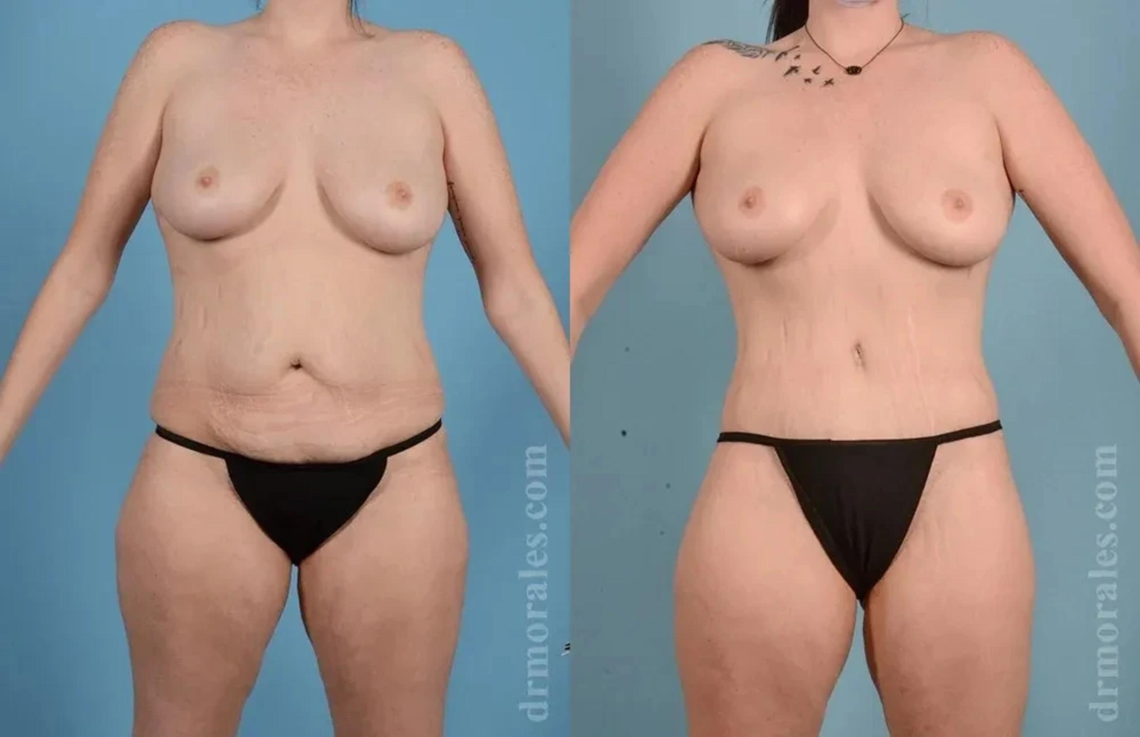 Before & After Body Lift Case 126 View 1 View in Houston, TX