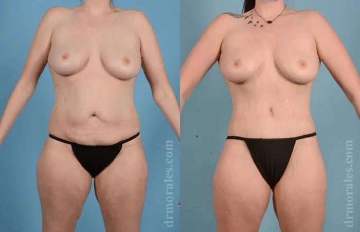 Before & After Body Lift Case 126 View 1 View in Houston, TX