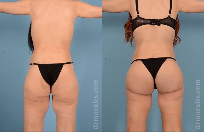 Before & After Body Lift Case 34 View 1 View in Houston, TX