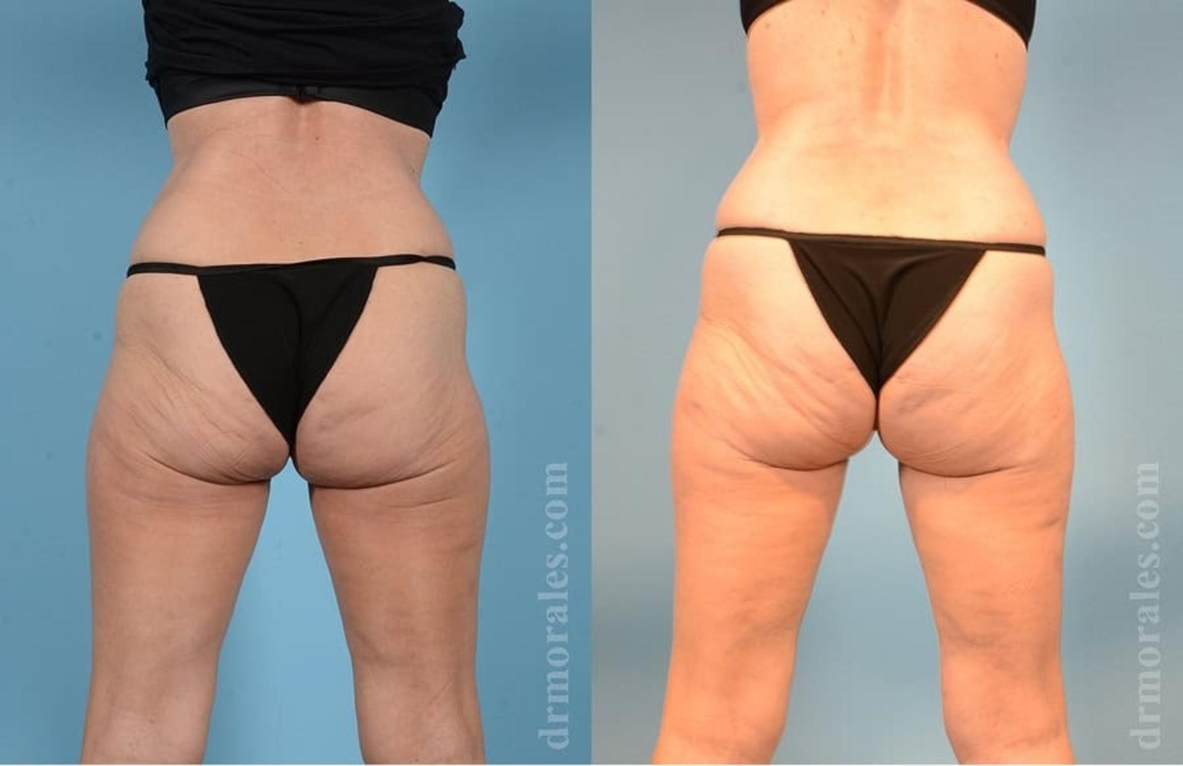Before & After Body Lift Case 35 View 1 View in Houston, TX