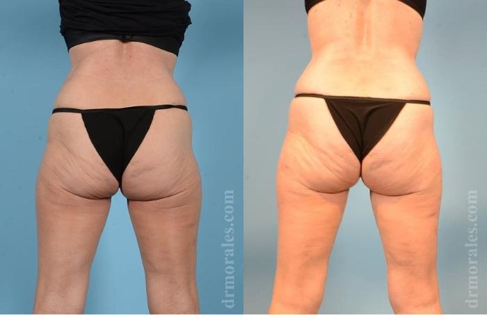 Before & After Body Lift Case 35 View 1 View in Houston, TX