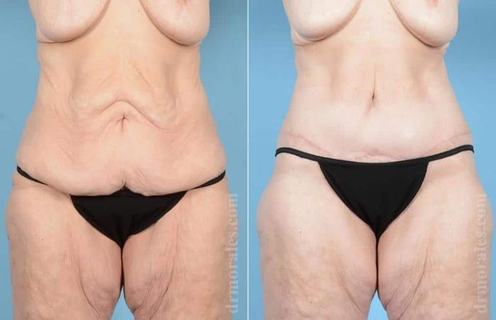 Before & After Body Lift Case 48 View 1 View in Houston, TX