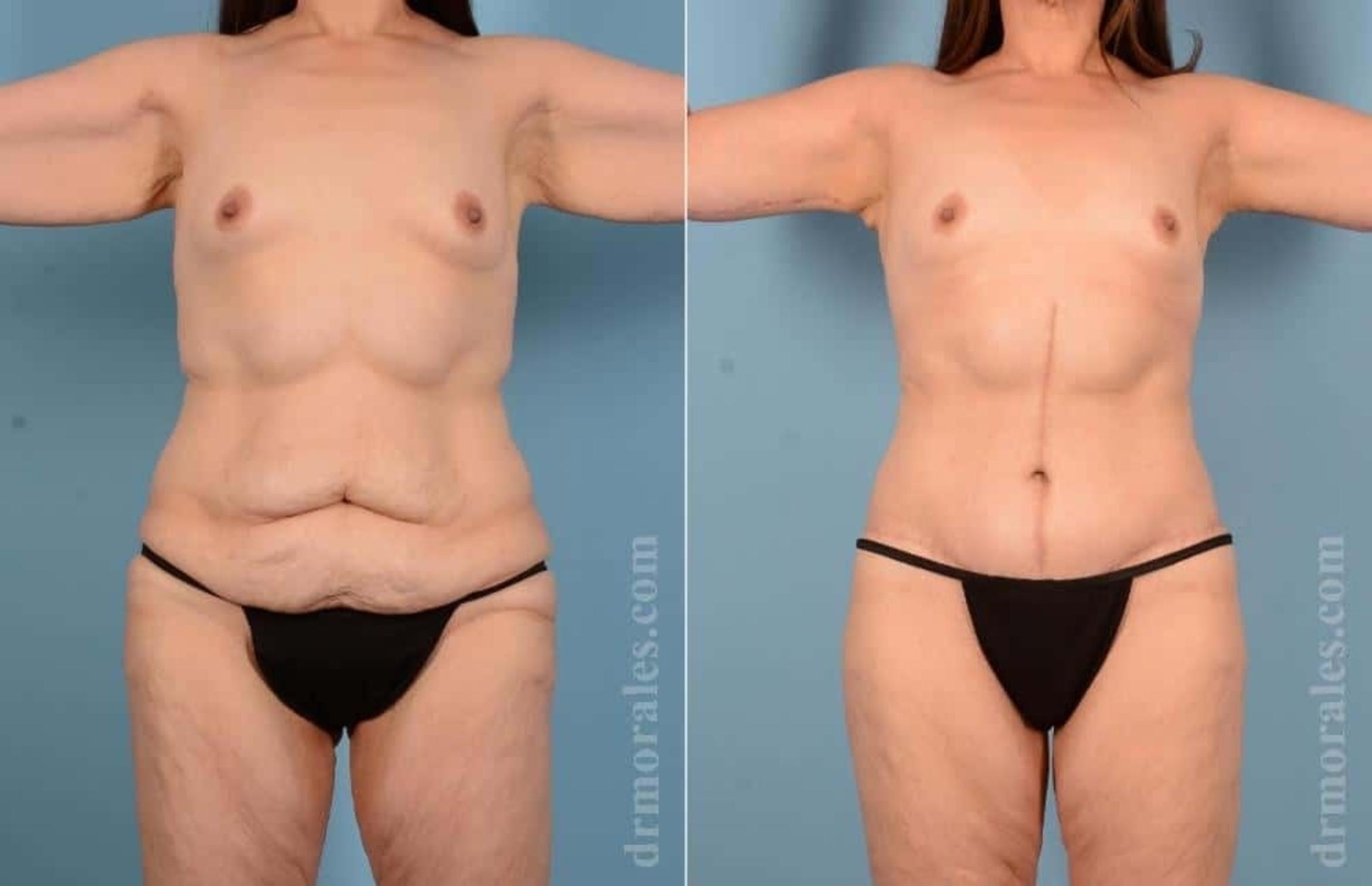 Before & After Body Lift Case 49 View 1 View in Houston, TX