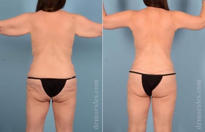 Before & After Body Lift Case 50 View 1 View in Houston, TX