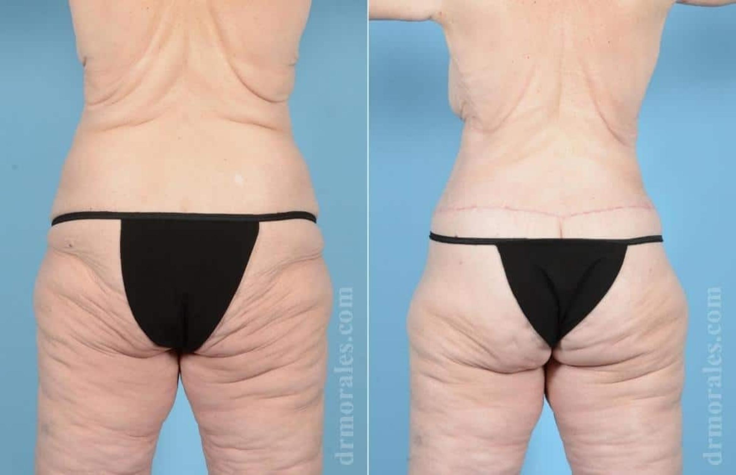 Before & After Body Lift Case 52 View 1 View in Houston, TX