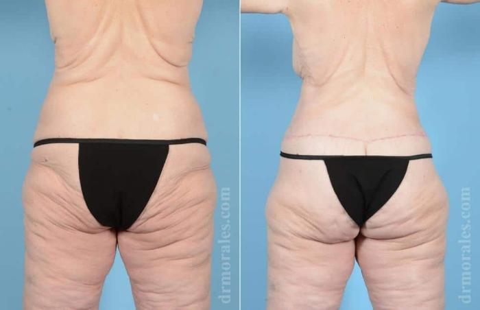 Before & After Body Lift Case 52 View 1 View in Houston, TX