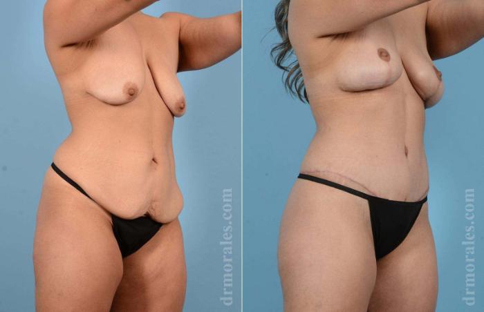 Before & After Body Lift Case 7 View 1 View in Houston, TX