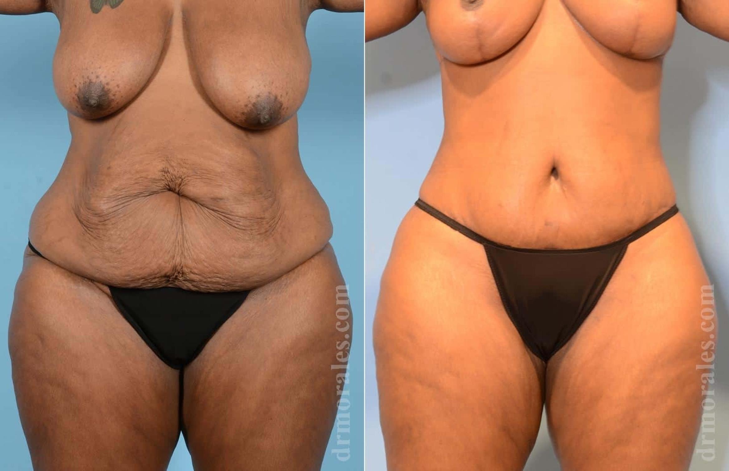 Before & After Body Lift Case 8 View 1 View in Houston, TX