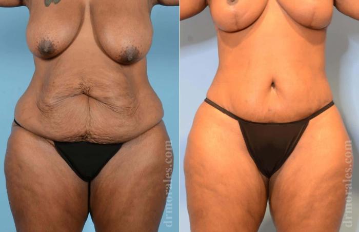 Before & After Body Lift Case 8 View 1 View in Houston, TX