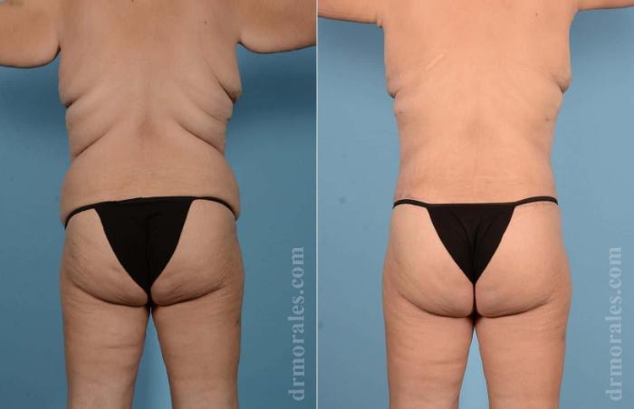 Before & After Body Lift Case 91 View 1 View in Houston, TX