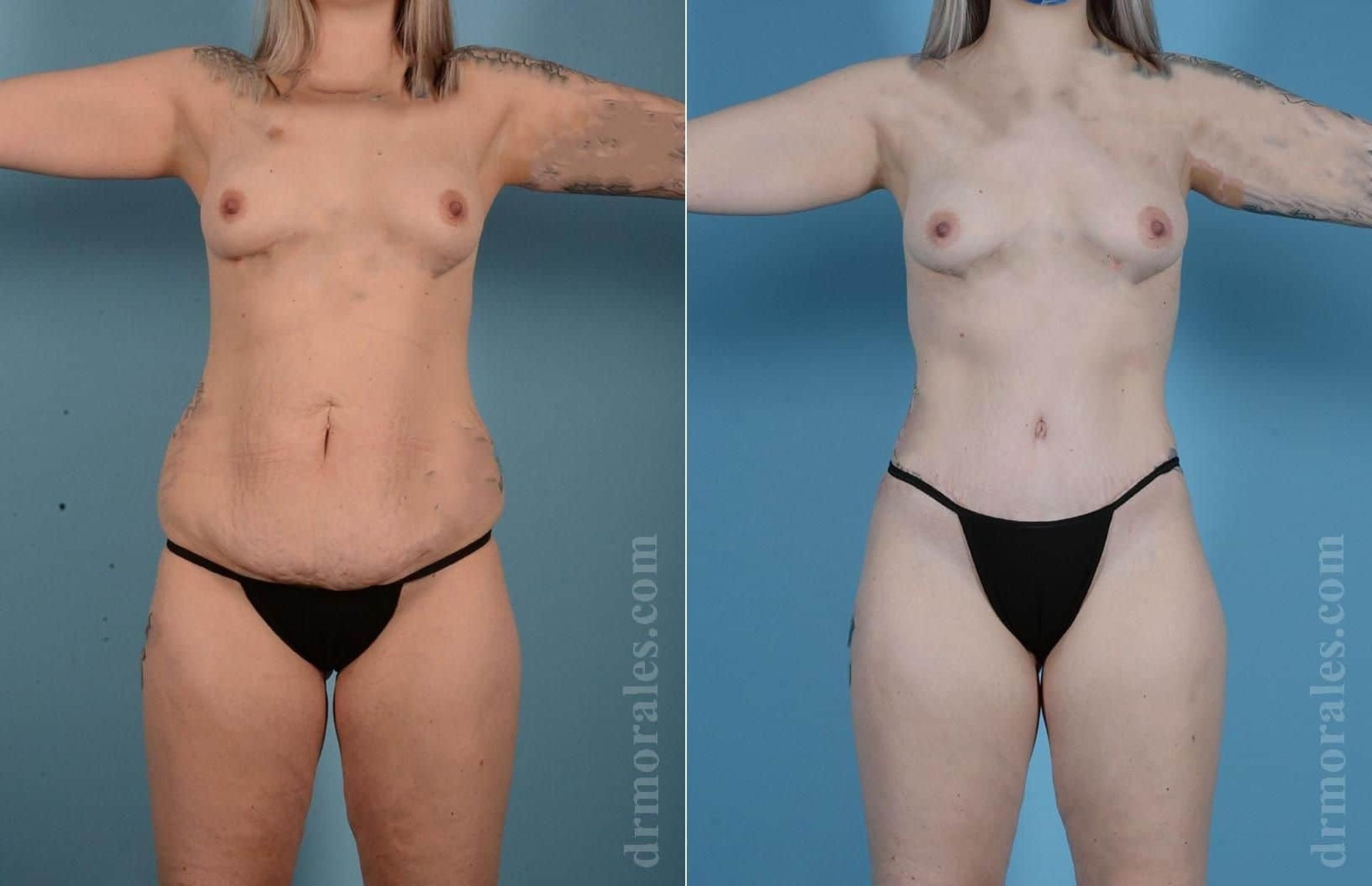 Before & After Body Lift Case 93 View 1 View in Houston, TX