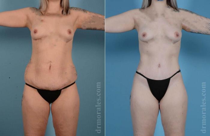 Before & After Body Lift Case 93 View 1 View in Houston, TX