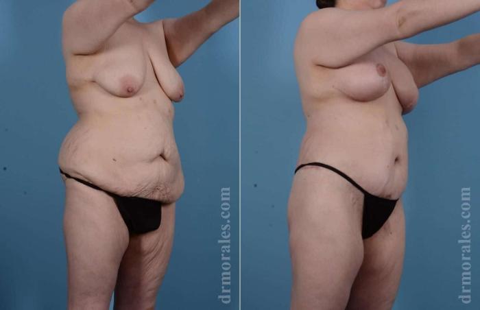 Before & After Body Lift Case 97 View 1 View in Houston, TX