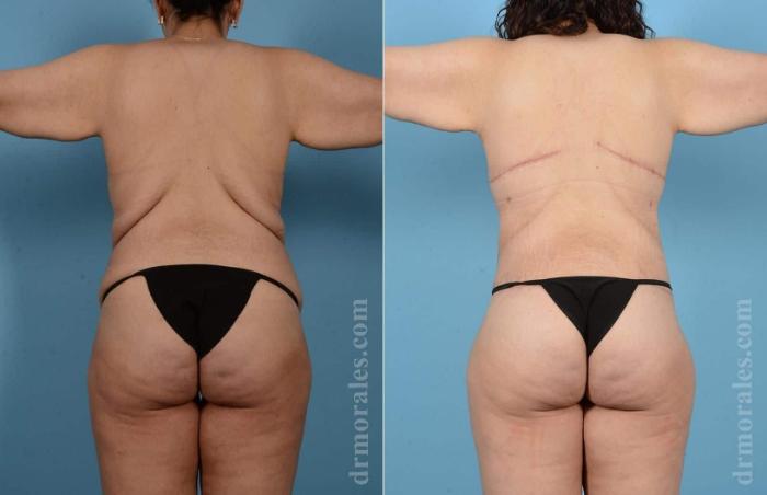 Before & After Bra Line Lift Case 103 View 1 View in Houston, TX