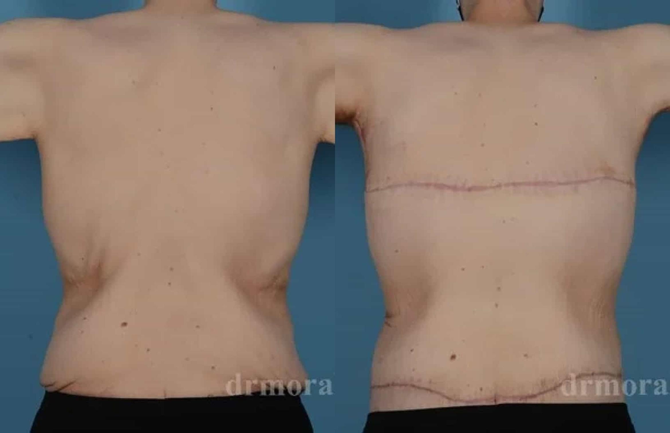 Before & After Bra Line Lift Case 223 View 1 View in Houston, TX
