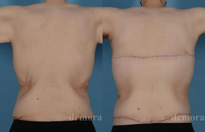 Before & After Bra Line Lift Case 223 View 1 View in Houston, TX