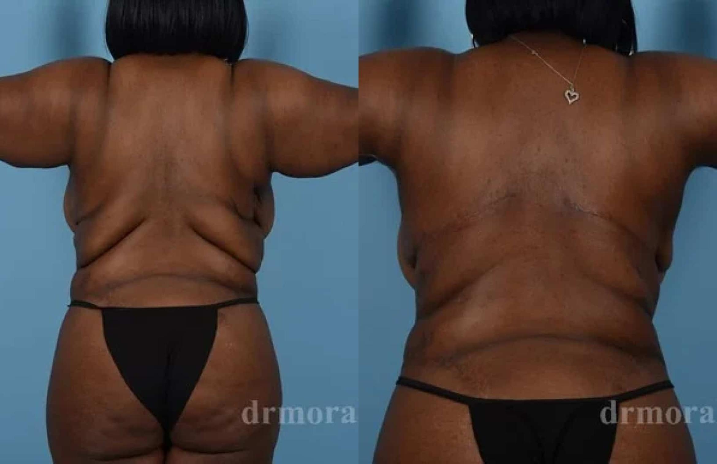 Before & After Bra Line Lift Case 224 View 1 View in Houston, TX