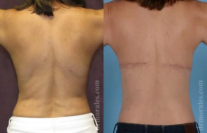 Before & After Bra Line Lift Case 225 View 1 View in Houston, TX