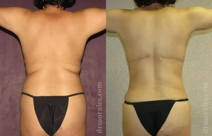 Before & After Bra Line Lift Case 226 View 1 View in Houston, TX
