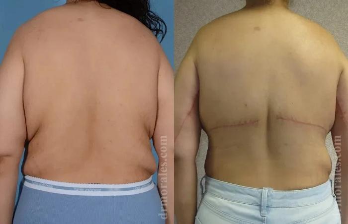 Before & After Bra Line Lift Case 227 View 1 View in Houston, TX