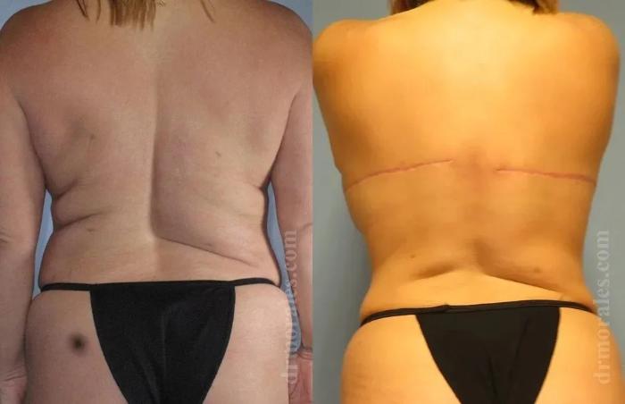 Before & After Bra Line Lift Case 228 View 1 View in Houston, TX