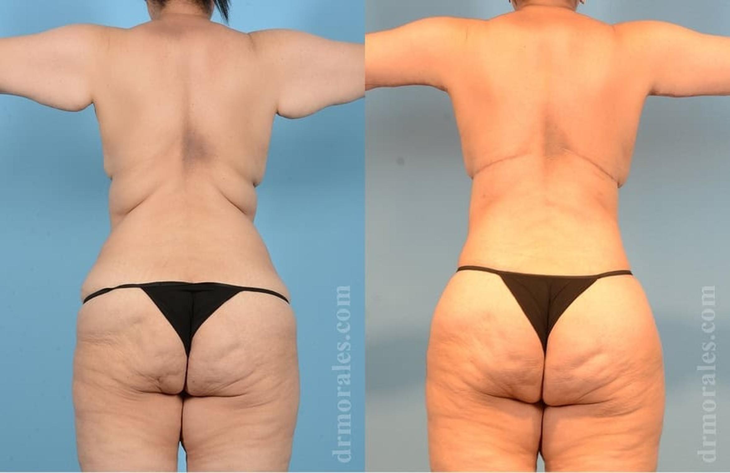 Before & After Bra Line Lift Case 26 View 1 View in Houston, TX