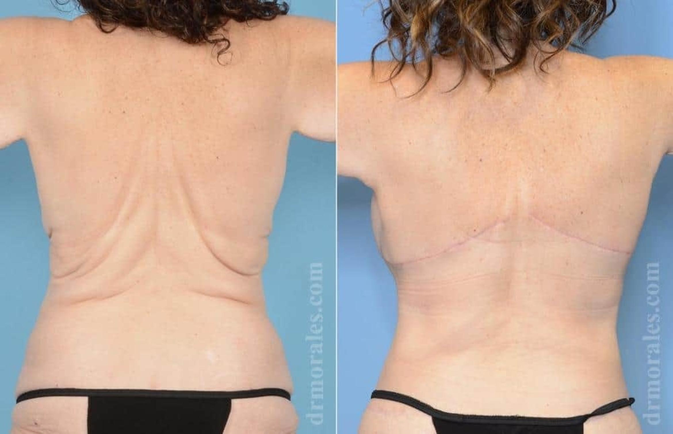 Before & After Bra Line Lift Case 45 View 1 View in Houston, TX