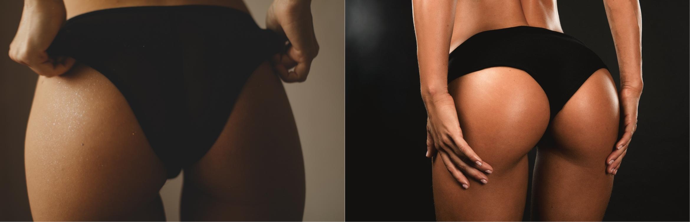 Before & After Brazilian Butt Lift Case 1 Back View in Houston, TX