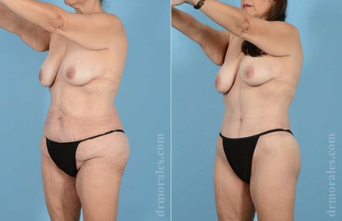 Before & After Brazilian Butt Lift Case 21 View 1 View in Houston, TX