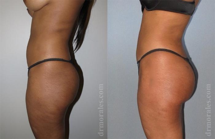 Before & After Brazilian Butt Lift Case 363 View 1 View in Houston, TX