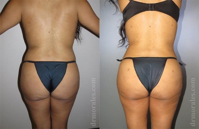 Before & After Brazilian Butt Lift Case 364 View 1 View in Houston, TX