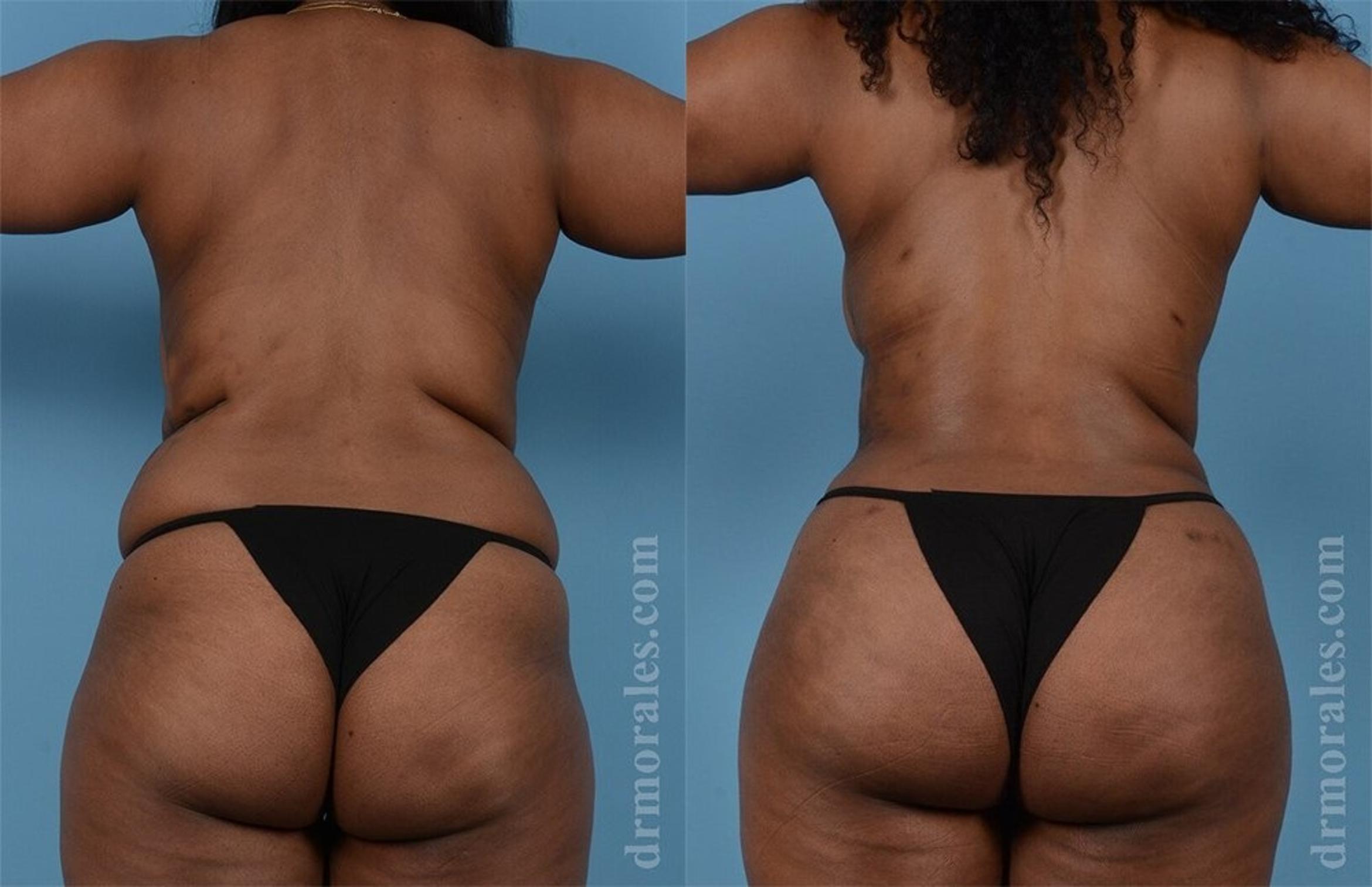 Before & After Brazilian Butt Lift Case 365 View 1 View in Houston, TX